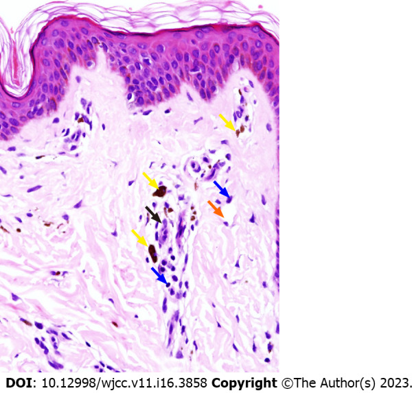 Purpura annularis telangiectodes of Majocchi: A case report - PMC