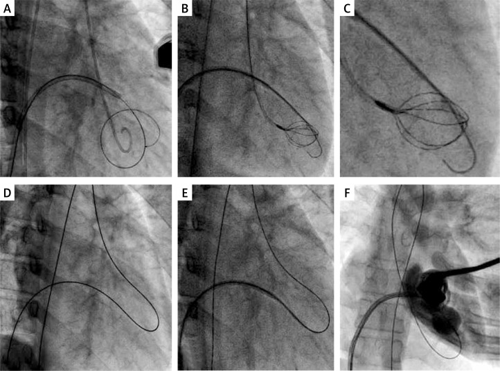 Percutaneous mitral balloon valvuloplasty difficult mitral valve