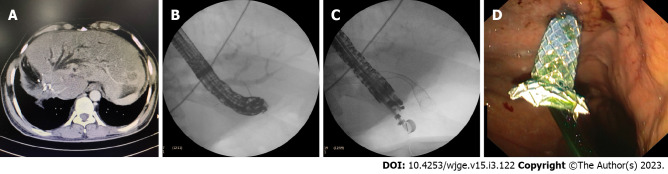 Endoscopic Ultrasound Guided Biliary Drainage In Surgically Altered Anatomy A Comprehensive