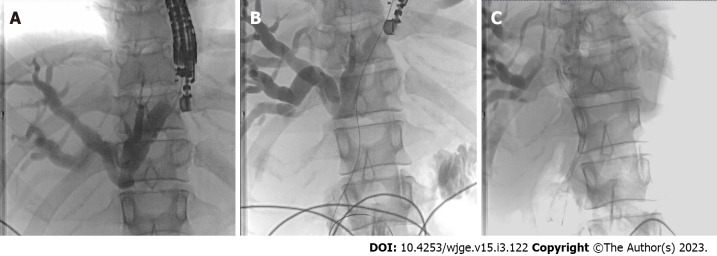 Endoscopic Ultrasound Guided Biliary Drainage In Surgically Altered Anatomy A Comprehensive