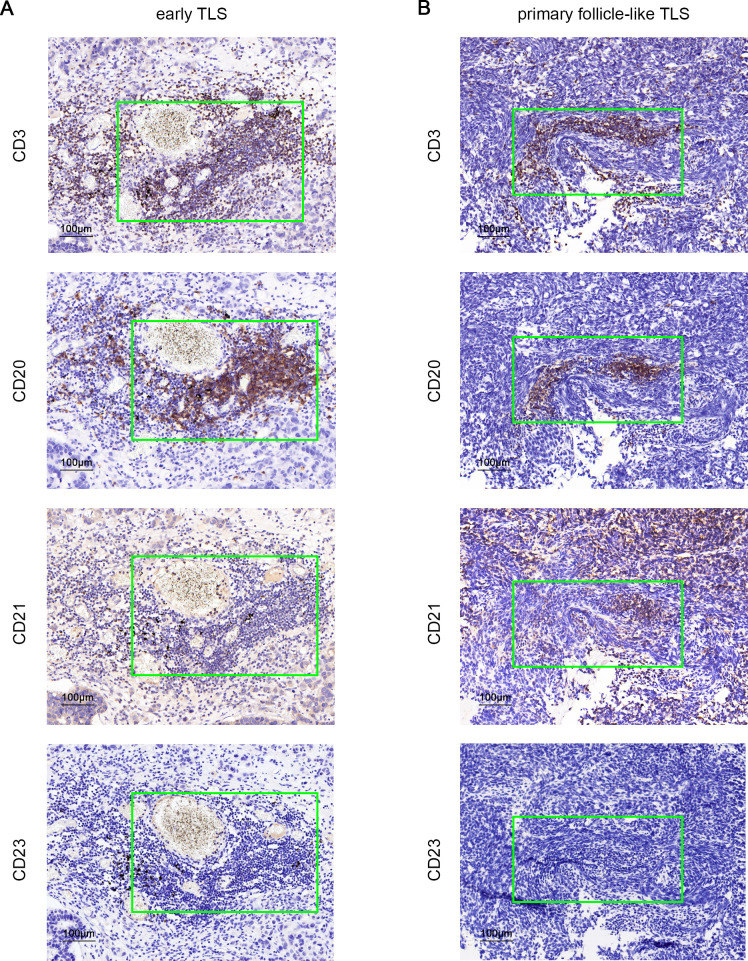 Density of tertiary lymphoid structures predicts clinical outcome in ...