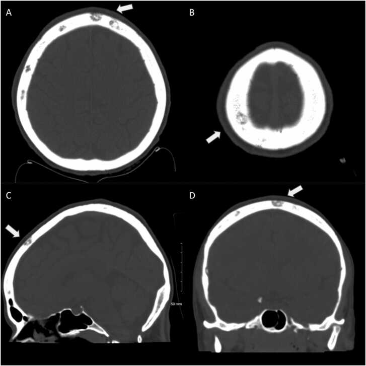 Calvarial lytic lesions in neurosyphilis with ocular involvement pmc