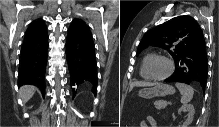 Focal eventration of diaphragm with fat content - PMC