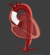 Gore Ascending Stent graft implanted for type A aortic dissection. Reprinted with permission