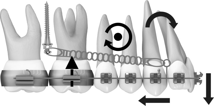 Total arch maxillary distalization using infrazygomatic crest ...