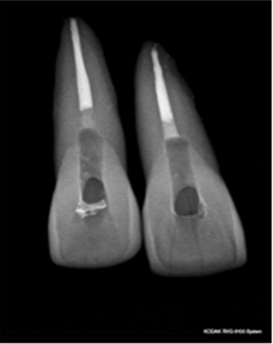 Fig. 1: Radiograph of maxillary centrals obturated with gutta-percha & AH plus sealer and 2mm GIC barrier.