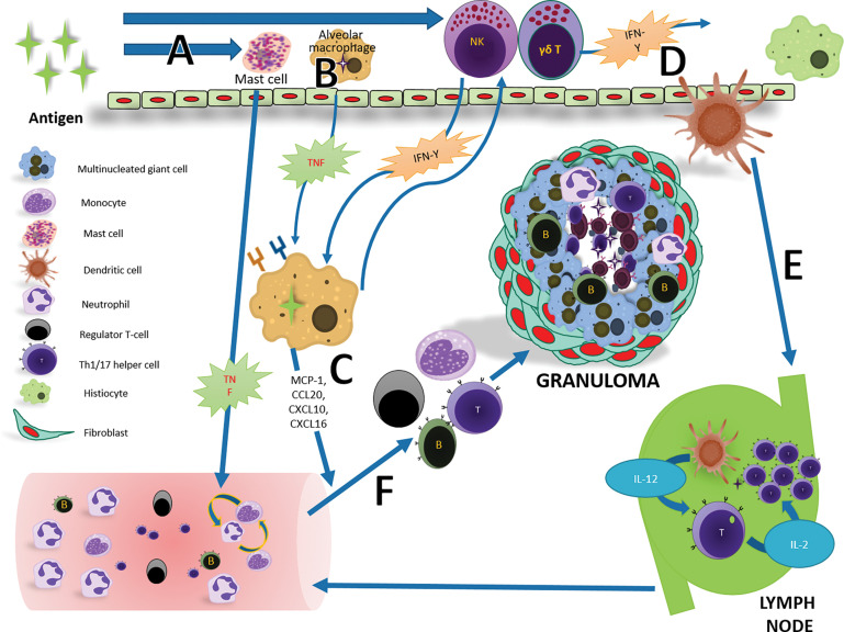 Diagram illustrates the simplified version of granuloma formation in sarcoidosis. A, Antigen triggers the mast cells to release tissue necrosis factor (TNF), which in turn activates the neutrophils in the bloodstream, which then activate the monocytes. B, Tissue macrophages take the antigen and release tissue necrosis factor alpha, which initiates upregulation of activation and adhesion molecules. C, Activated macrophages produce chemokine ligands (monocyte chemoattractant protein 1 [MCP-1], chemokine [C-C motif] ligand 20 [CCL20], C-X-C motif chemokine ligand 10 [CXCL10], C-X-C motif chemokine ligand 16 [CXCL16]) by means of stimulation of both tissue necrosis factor alpha and natural killer (NK) cell–derived interferon gamma (IFN-γ), thereby attracting Th1 and type 17 T-helper (Th1/17) cells, monocytes, regulatory T cells (Tregs), and B cells. D, The interferon gamma produced by local natural killer cells and gamma delta T (γδT) cells further activates resident tissue histiocytes and dendritic cells. E, Activated antigen-loaded dendritic cells then migrate to peripheral lymph nodes via the lymphatic channels. F, The dendritic cell produces interleukin-12 (IL-12) and presents antigen to the naïve CD4 T cell. Under the influence of interleukin-12, naïve T cells mature into Th1 cells. Activated Th1 cells then produce interleukin-2 (IL-2), which expands the T-cell population. Then, these Th1 cells traffic to sites of inflammation and aid in the formation of granuloma by maturing macrophages. Over the course of days, mature granuloma, along with other cells, is formed if antigen persists.
