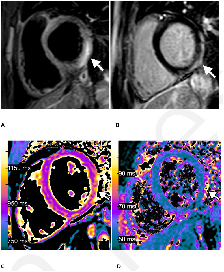 Myocarditis following COVID-19 vaccination in a 15-year-old boy. One day after receiving his second vaccination dose he developed fever, myalgia, and intermittent tachycardia: (A) T2-weighted short TI inversion recovery MRI at 1.5 T in short-axis view shows focal high signal intensities at the basal lateral and inferior wall (arrow) indicating myocardial edema. (B) Late gadolinium enhancement imaging in short-axis view displays corresponding linear subepicardial enhancement (arrow) indicating inflammatory myocardial necrosis. (C) T1 mapping and (D) T2 mapping in short-axis view show elevated T1 and T2 relaxation times at the mid ventricular lateral and inferolateral wall (arrows), indicating acute myocardial injury (focal T1 relaxation time: 1165 ms, focal T2 relaxation time: 70 ms; institution-specific cutoff values for acute myocarditis: T1 global: ≥1000 ms, T2 global: ≥55.9 ms).