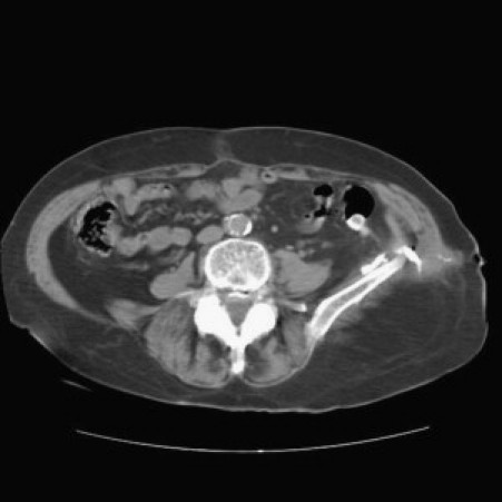 Colocutaneous fistula complicating sigmoid diverticulitis - PMC