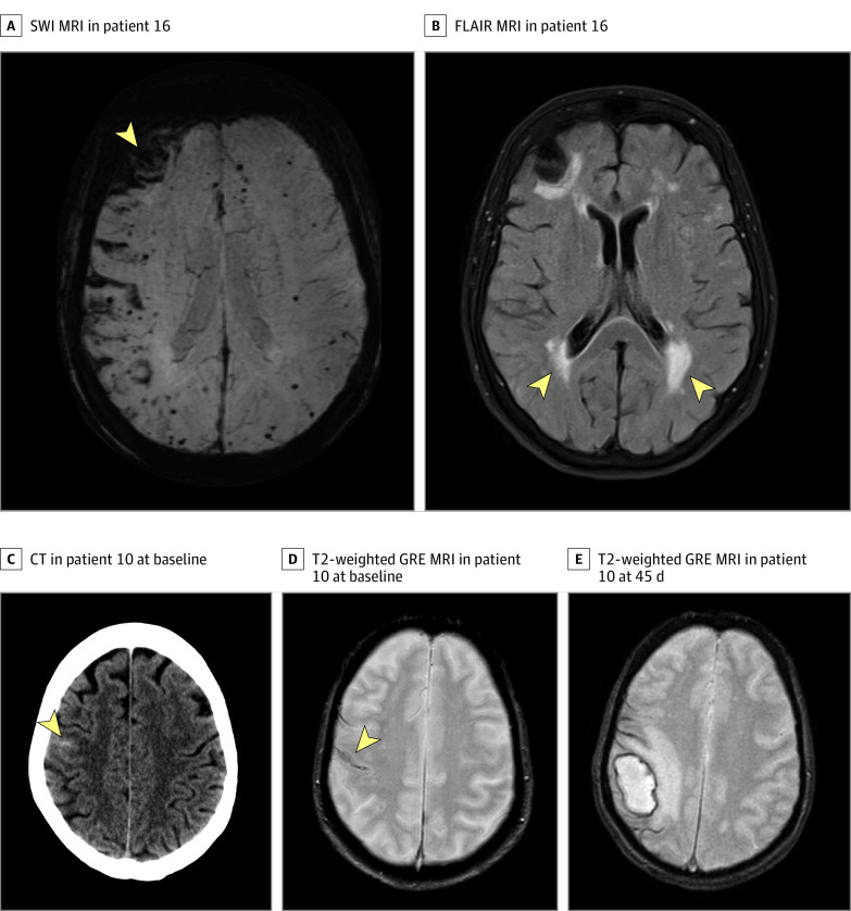 Transient Focal Neurological Events In Cerebral Amyloid Angiopathy And The Long Term Risk Of