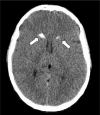 Brain CT shows bilateral calcifications in CN, white arrows