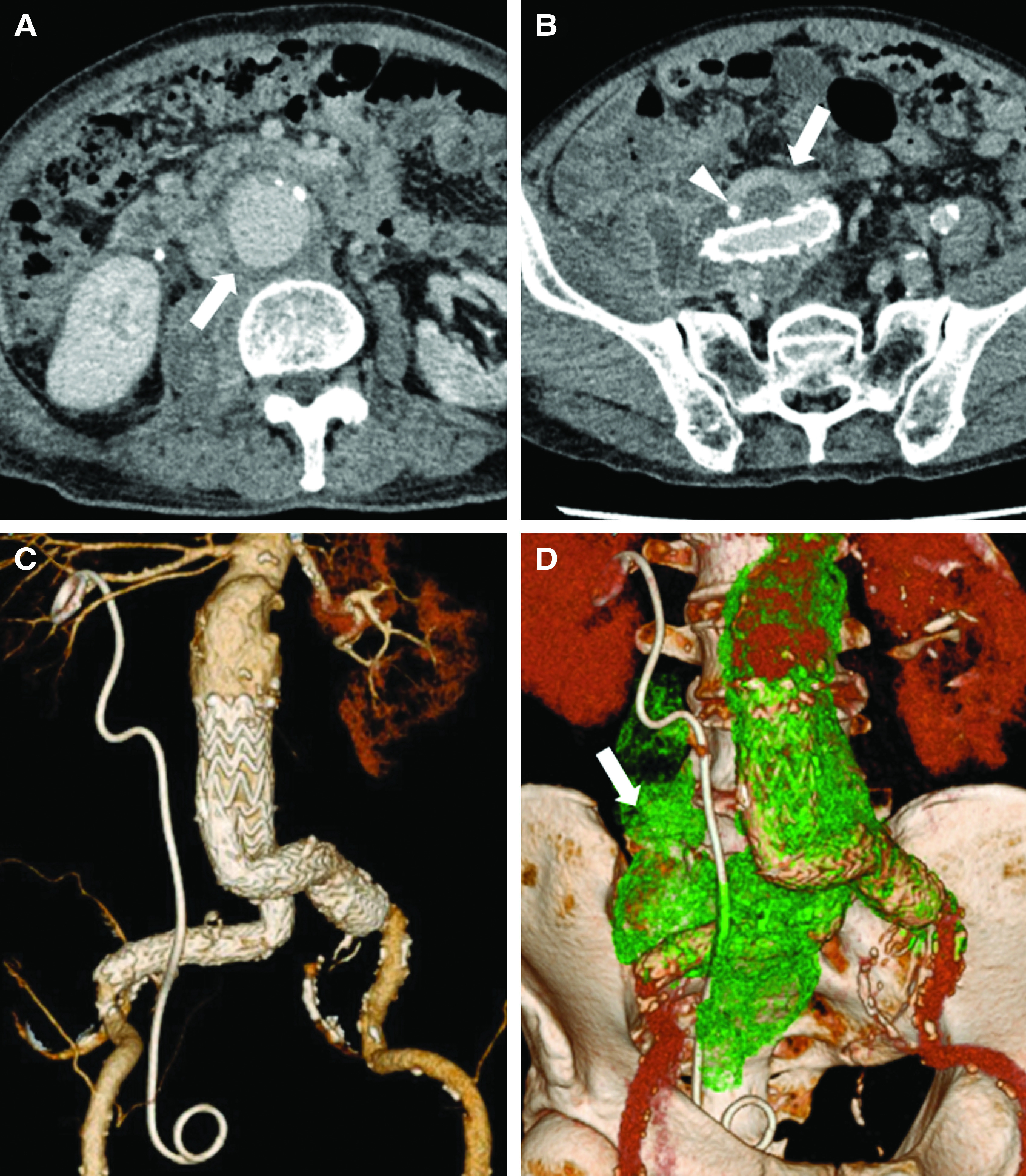 Aortobifemoral Bypass Grafting with Reversed L-Shaped Technique for ...