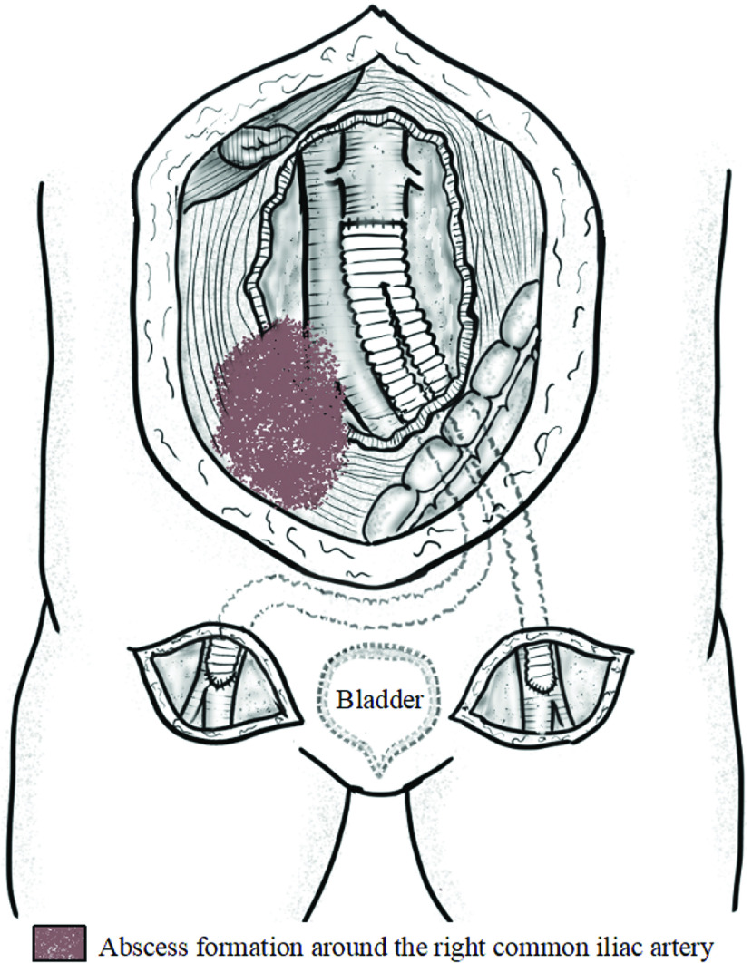 Aortobifemoral Bypass Grafting with Reversed L-Shaped Technique for ...