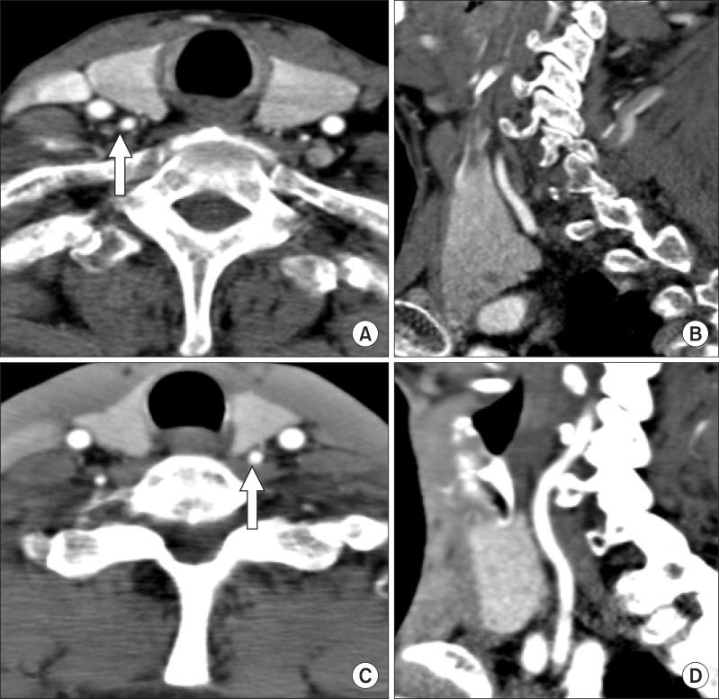 variations-in-entrance-of-vertebral-artery-in-korean-cervical-spine