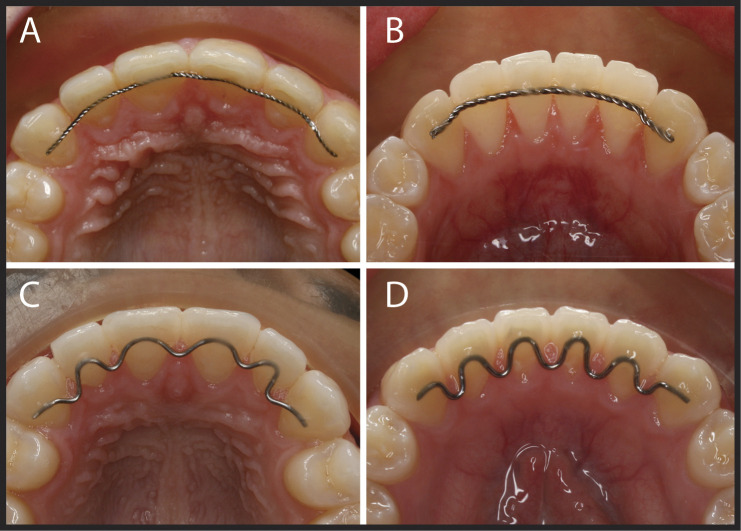 Figure 1. Fixed bonded retainers. (A) Maxillary straight retainer. (B) Mandibular straight retainer. (C) Maxillary wave retainer. (D) Mandibular wave retainer.