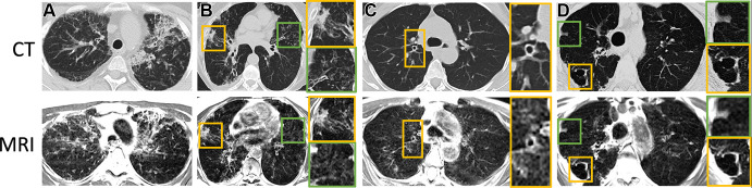 Axial CT (reformatted to 0.8 × 0.8 × 6 mm) and T2-weighted MR (reformatted to 1.1 × 1.1 × 6 mm) images show (A) honeycombing, interstitial thickening, and fibrotic changes in a 35-year-old woman; (B) consolidative opacities in a 70-year-old woman; (C) bronchial wall thickening with bronchiectasis in a 58-year-old woman; and (D) a cavitary lesion in a 70-year-old woman. (B–D) Green and yellow boxes on CT and MR images denote the area of interest around the particular finding described, with the corresponding box bordered in that color to the right of the respective image showing an enlarged view of the area.