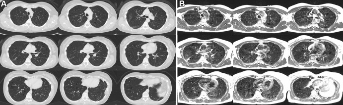 Axial multisection imaging yielded full lung coverage using (A) CT (reformatted to 0.8 × 0.8 × 6 mm) and (B) T2-weighted MRI (1.1 × 1.1 × 6 mm) in a 41-year-old woman with lymphangioleiomyomatosis resulting in innumerable thin-walled pulmonary cysts.