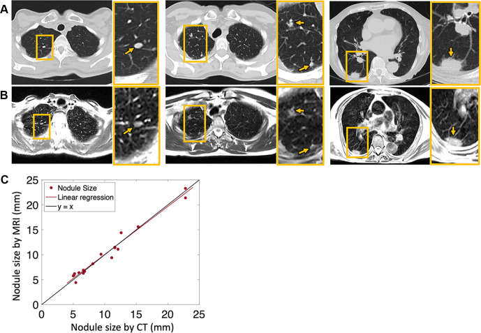 Axial imaging of pulmonary nodules (arrows) with (A) CT (reformatted to 0.8 × 0.8 × 6 mm) and (B) T2-weighted MRI (1.1 × 1.1 × 6 mm) in three different patients—a 58-year-old woman (left), a 64-year-old woman (middle), and an 88-year-old woman (right). (C) Pulmonary nodules varying in size from 5 to 23 mm, measured using both CT and MRI, show strong correlation in the patient sample. Yellow boxes denote areas of interest that are enlarged in the yellow-bordered box to the right of each respective image.