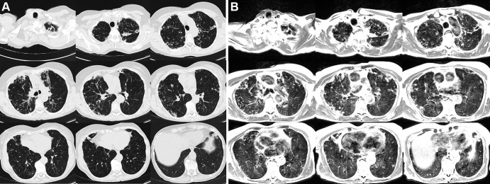 Axial multisection imaging yielded full lung coverage using (A) CT (reformatted to 0.8 × 0.8 × 6 mm) and (B) T2-weighted MRI (1.1 × 1.1 × 6 mm) in a 69-year-old woman with bronchiectasis, cavitary lesions, and scattered pulmonary nodules.