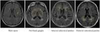 Four brain MRI images showing different types of lesions. The first image highlights a multi-spot lesion, the second shows lesions near the peri-basal ganglia, the third displays anterior subcortical patches, and the fourth depicts posterior subcortical patches. Yellow outlines or markings are used to indicate specific areas of interest in each image.