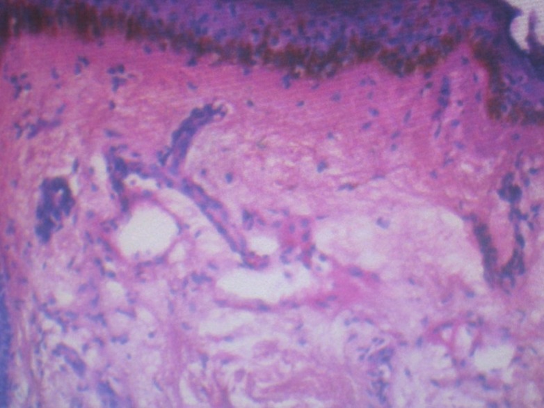 Carcinoma en Cuirasse: A Cutaneous Clue for Systemic Malignancy - PMC