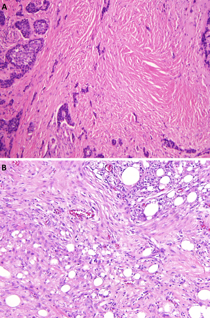 Mesenteric Tumor Deposits Arising from Small Intestinal Neuroendocrine ...