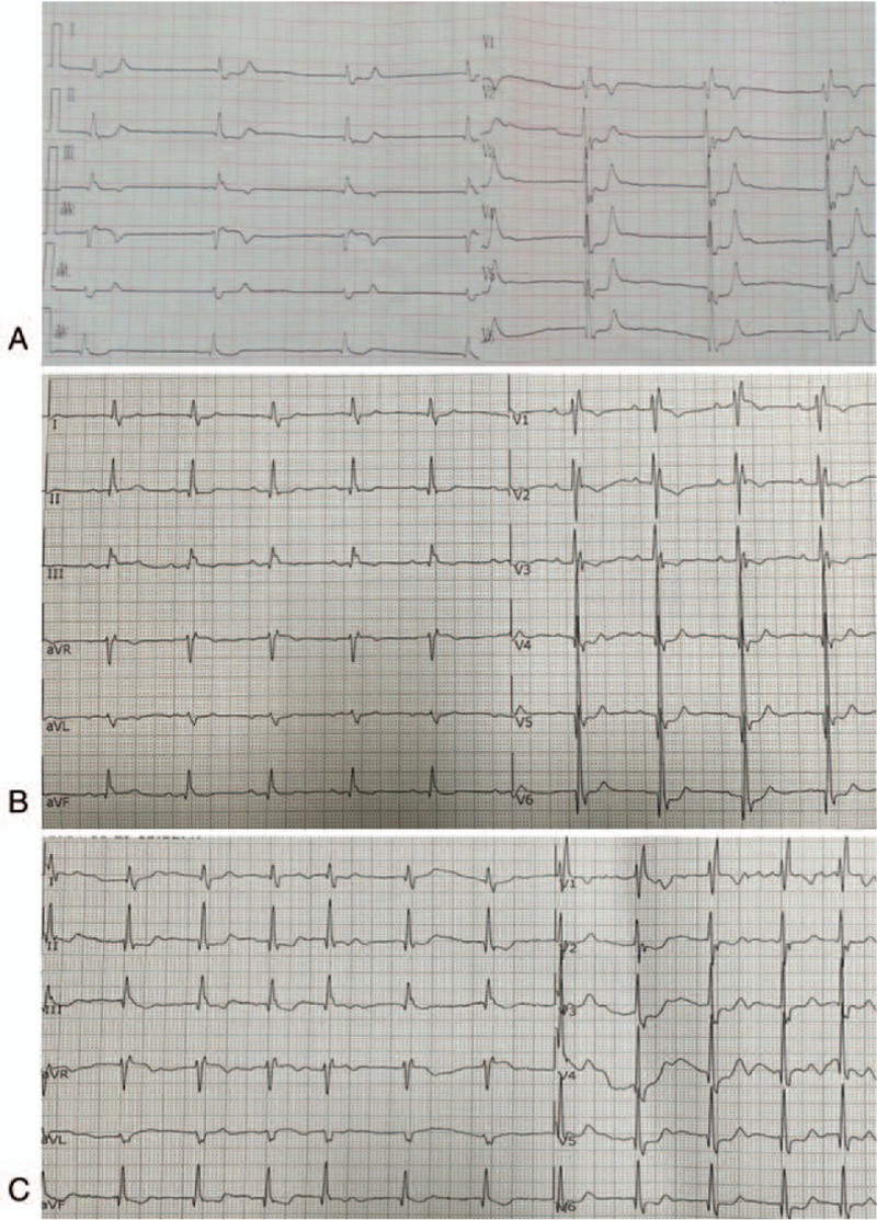 Spontaneous conversion of atrial fibrillation caused by severe