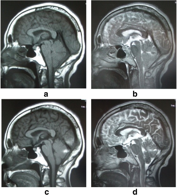 Remote cerebellar hemorrhage following thoracic spinal surgery of an ...