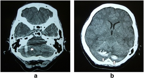 Remote cerebellar hemorrhage following thoracic spinal surgery of an ...