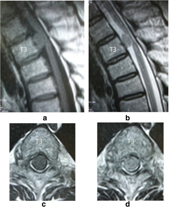 Remote cerebellar hemorrhage following thoracic spinal surgery of an ...