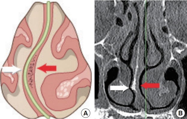 Deviated nose: Physiological and pathological changes of the nasal ...