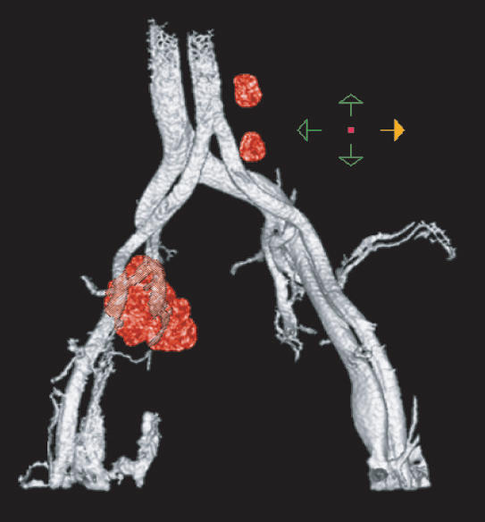 3-D image of lymph node after automated analysis