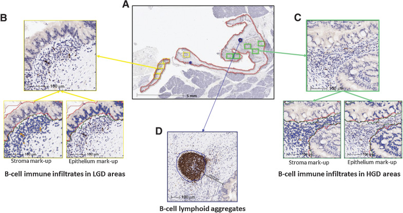 Figure 2. Analysis of B-cell immune infiltrates and B-cell lymphoid aggregates in IPMNs by IHC for CD20 and digital image analysis. A, Low-magnification image of a high-grade IPMN with cyst area (red line) B-cell lymphoid aggregates (blue line), LGD (yellow boxes) and HGD (green boxes) areas selected for image analysis. B and C show high magnification images of LGD and HGD areas and mark-up images of CD20-positive cells (orange) in stromal and dysplastic epithelial/carcinoma compartments. D, shows a high magnification image of a B-cell lymphoid aggregate (blue line).