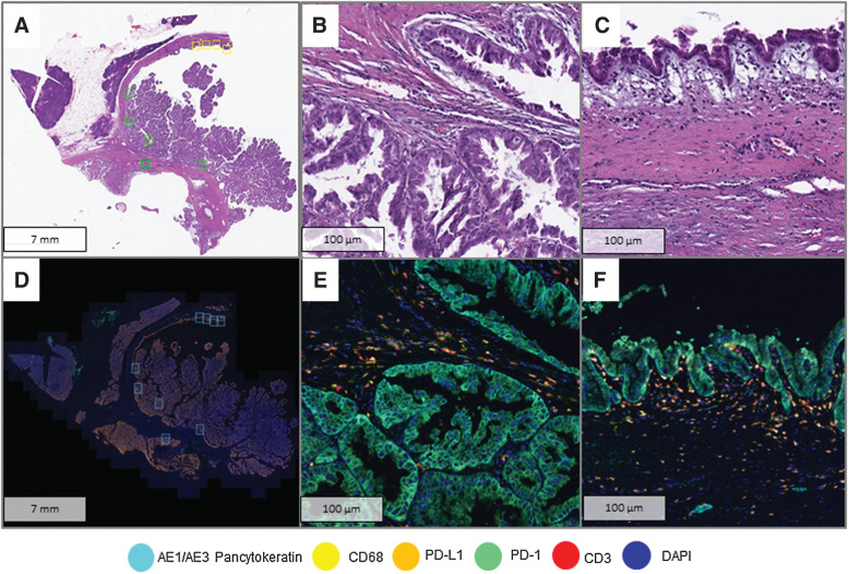 Figure 1. Analysis of immune cell infiltrates using mIF. A, Whole section H&E slide of a high-grade IPMN with HGD areas (yellow squares) and LGD areas (green squares) selected for digital image analysis. B, HGD area at high resolution (40×). C. LGD area at high resolution (40×). D, Image scan of Phenochart with selected areas for high magnification (blue squares). E, Panel 1 composite of HGD area (40×). F, Panel 1 composite of LGD area.