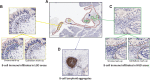 Figure 2. Analysis of B-cell immune infiltrates and B-cell lymphoid aggregates in IPMNs by IHC for CD20 and digital image analysis. A, Low-magnification image of a high-grade IPMN with cyst area (red line) B-cell lymphoid aggregates (blue line), LGD (yellow boxes) and HGD (green boxes) areas selected for image analysis. B and C show high magnification images of LGD and HGD areas and mark-up images of CD20-positive cells (orange) in stromal and dysplastic epithelial/carcinoma compartments. D, shows a high magnification image of a B-cell lymphoid aggregate (blue line).