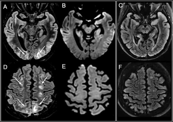 Posterior reversible encephalopathy syndrome (PRES). A 66-year-old male infected with SARS-CoV-2 presenting with status epilepticus in a context of pneumonia and severe hyponatremia. There were cortico-subcortical signal abnormalities in the parieto-occipital and superior frontal regions on FLAIR images (A and D, arrows), with no diffusion restriction (B and E). Follow-up MRI performed ten days later showed complete disappearance of the lesions (C, F).