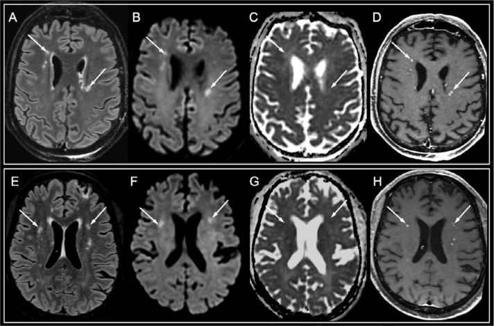 White matter enhancing lesions. A 50-year-old man with a history of kidney transplantation (A-D) and a 50-year-old ICU man with type 2 diabetes (E-H), who presented with late awakening following sedation withdrawal after 39 and 65 days of intensive care for severe hypoxic SARS-CoV-2-associated pneumonia complicated with severe acute respiratory syndrome, respectively. Both patients progressively recovered consciousness and were able to respond to orders. A similar imaging pattern than that in Figure 4 was seen, but with fewer white matter lesions appearing hyperintense on FLAIR images (A, E, arrows) and diffusion-weighted images (B, F, arrows), without apparent diffusion coefficient decrease (C, G, arrows), with a perivascular enhancement on post-contrast T1-weighted images (D, H, arrows). Abbreviation: SARS-CoV-2: severe acute respiratory syndrome coronavirus 2.