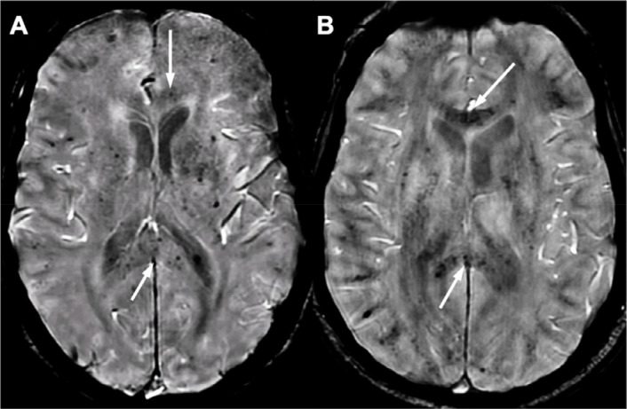 Microhemorrhages. Diffuse microhemorrhages involving the corpus callosum in two patients in intensive care on extracorporeal membrane oxygenation (EMCO, A, arrows) and without ECMO (B, arrows) Abbreviations: ECMO: extracorporeal membrane oxygenation.