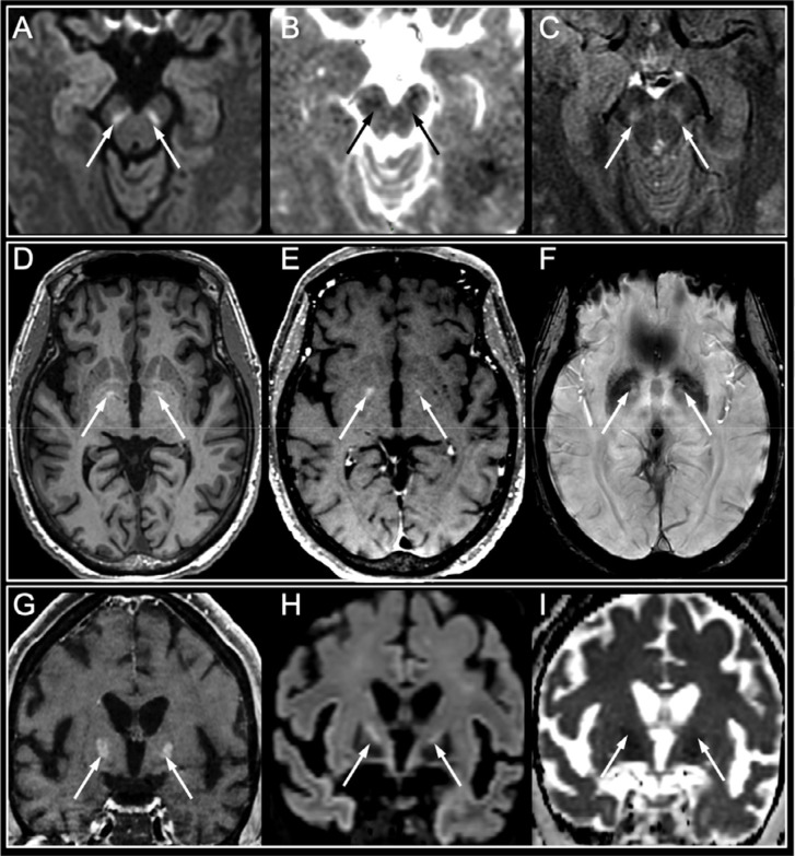 Basal ganglia abnormalities. Basal ganglia abnormalities in three patients who experienced late awakening after sedation withdrawal in a context of SARS-CoV-2 hypoxic pneumonia with severe acute respiratory syndrome: 1) A 42-year-old male with untreated chronic lymphocytic leukemia who had tetraparesis upon awakening after 47 days of intensive care (A-C). Hyperintensity on DWI within the substantia nigra (A, arrows) with decreased apparent diffusion coefficient (B, arrows) and hyperintensity on axial FLAIR images (C, arrows) were seen. The follow-up neurological examination showed complete consciousness recovery with persistent peripheral motor deficit consistent and mild parkinsonian symptoms. 2) A 62-year-old diabetic female with chronic cardiovascular disease, who suffered cardiorespiratory arrest after 54 days of intensive care (D-F). Hyperintensity on pre-contrast MPRAGE axial T1-weighted images in the globus pallidus (D, arrows), with no enhancement on post-contrast T1-weighted images (E, arrows) or hypointensity on susceptibility-weighted images (F, arrows). The follow-up neurological examination also showed complete consciousness recovery with a persistent motor deficit. 3) A 56-year-old diabetic and obese female who experienced late awakening after 48 days of intensive care (G-I). Bilateral enhancement within the globus pallidus on coronal post-contrast T1-weighted images (G, arrows), with hyperintensity on diffusion-weighted images (G, arrows) and decreased apparent diffusion coefficient (H, arrows). No follow-up was available. Abbreviation: SARS-CoV-2: severe acute respiratory syndrome coronavirus 2