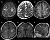 White matter enhancing lesions. A 37-year-old obese male with no medical history, admitted to ICU for SARS-CoV-2-associated pneumonia ten days after the onset of flu-like symptoms, who developed severe acute respiratory syndrome, recurrent venous thrombo-embolism with negative thrombophilia tests, and multiple organ failure. MRI is performed for late awakening following withdrawal of sedation after 38 days of intensive care. The patient did not recover consciousness and died 42 days after the brain MRI. There were symmetrical multifocal periventricular and deep white matter lesions, hyperintense on axial FLAIR images with a vacuolated appearance (A, arrows), without diffusion restriction (B, arrows), hypointense on T1-weighted images (C, arrows), and with a perivascular enhancement on post-contrast T1-weighted images (D E, F, arrows). These lesions were associated with white matter FLAIR hyperintensities (A, arrowhead) with decreased apparent coefficient diffusion (B, arrowhead). Abbreviations: SARS-CoV-2: severe acute respiratory syndrome coronavirus 2.