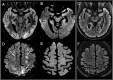 Posterior reversible encephalopathy syndrome (PRES). A 66-year-old male infected with SARS-CoV-2 presenting with status epilepticus in a context of pneumonia and severe hyponatremia. There were cortico-subcortical signal abnormalities in the parieto-occipital and superior frontal regions on FLAIR images (A and D, arrows), with no diffusion restriction (B and E). Follow-up MRI performed ten days later showed complete disappearance of the lesions (C, F).