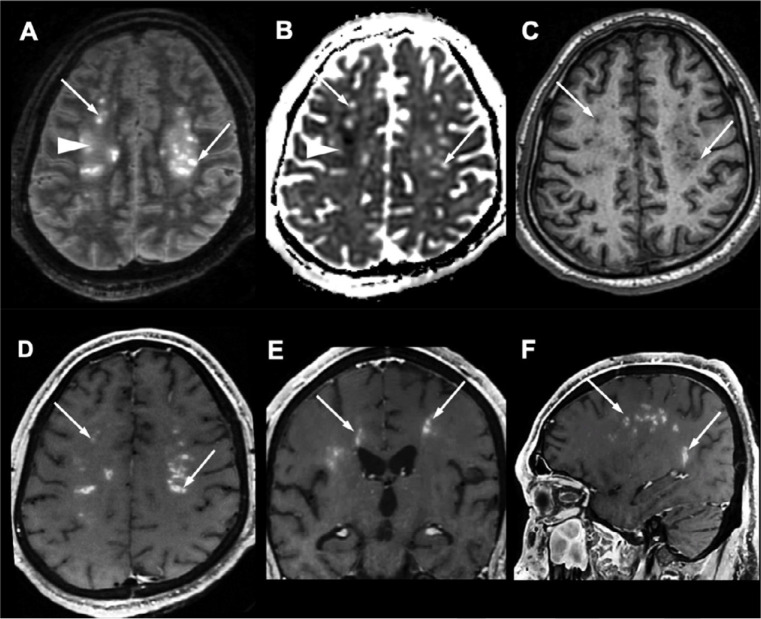 White matter enhancing lesions. A 37-year-old obese male with no medical history, admitted to ICU for SARS-CoV-2-associated pneumonia ten days after the onset of flu-like symptoms, who developed severe acute respiratory syndrome, recurrent venous thrombo-embolism with negative thrombophilia tests, and multiple organ failure. MRI is performed for late awakening following withdrawal of sedation after 38 days of intensive care. The patient did not recover consciousness and died 42 days after the brain MRI. There were symmetrical multifocal periventricular and deep white matter lesions, hyperintense on axial FLAIR images with a vacuolated appearance (A, arrows), without diffusion restriction (B, arrows), hypointense on T1-weighted images (C, arrows), and with a perivascular enhancement on post-contrast T1-weighted images (D E, F, arrows). These lesions were associated with white matter FLAIR hyperintensities (A, arrowhead) with decreased apparent coefficient diffusion (B, arrowhead). Abbreviations: SARS-CoV-2: severe acute respiratory syndrome coronavirus 2.