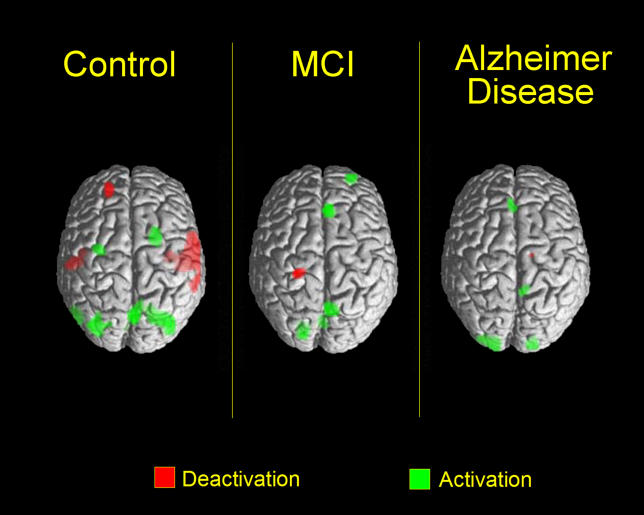 Cerebral activation and deactivation during spatial navigation