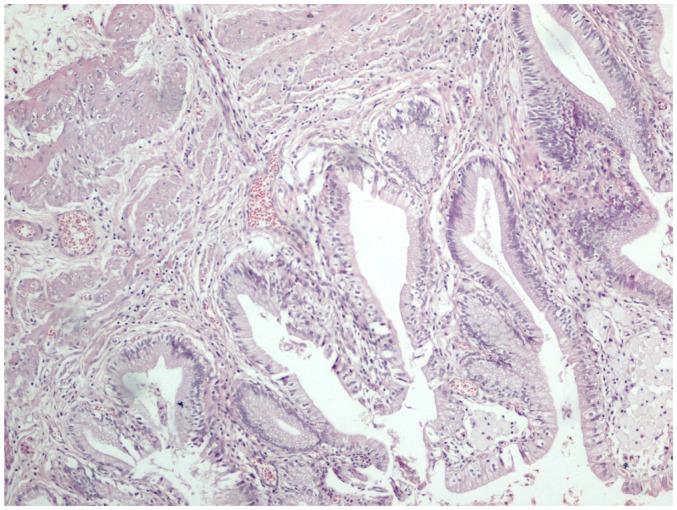 Early Laparoscopic Cholecystectomy Is Associated With Less Risk Of 