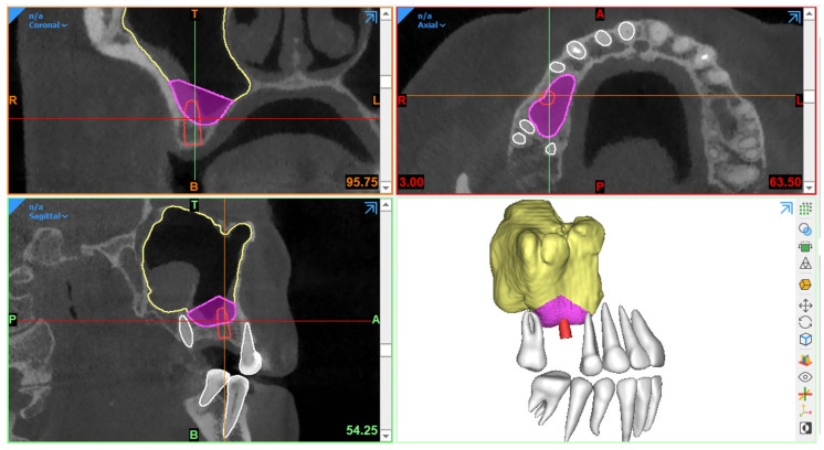 CBCT for Diagnostics, Treatment Planning and Monitoring of Sinus Floor ...