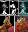 Images in a 56-year-old asymptomatic man referred for an elective coronary
calcium score stratification. (A, B) Axial CT scans, (C) axial two-dimensional
fluorine 18 (18F) fluorodeoxyglucose (FDG) PET/CT scan, and (D, E) tridimensional
reconstructions show a low-attenuation nodule (arrow), measuring 2.6 cm, with
intense and heterogeneous postcontrast enhancement, central nonenhancing areas, and
18F-FDG uptake (maximum standardized uptake value, 9.3) surrounded by the inferior
border of aortic arch, the posterior border of ascending aorta, the upper border of
the right main pulmonary artery, and the anterior border of the trachea and proximal
left main bronchus. Note the paraganglioma relationship with the posterior portion
of the superior aortic recess (arrowheads).