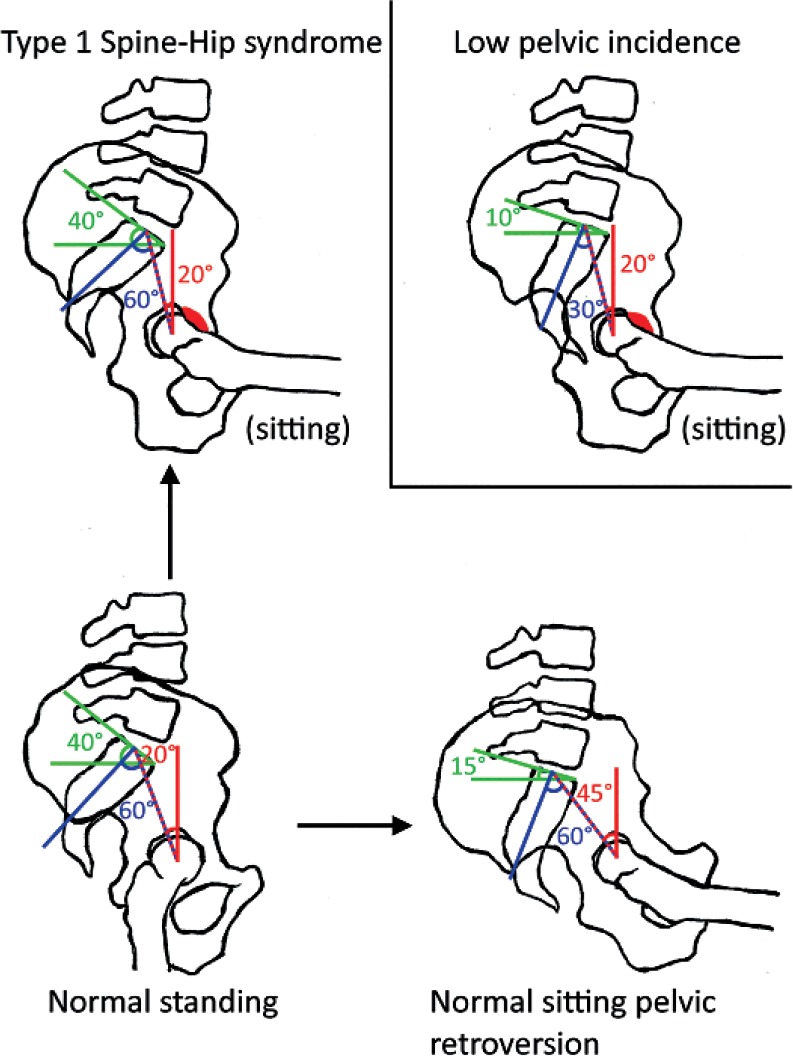 Spine–hip relations in patients with hip osteoarthritis - PMC