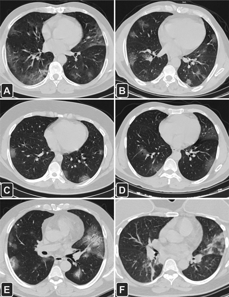 Transverse CT images of six patients with different outcomes (A, B) and management (C−F) for COVID-19 pneumonia. A, A 52-year-old man with a medical history of diabetes mellitus, hypertension, and ischemic heart disease had a complete recovery and was discharged (CT severity score = 13); B, A 55-year-old man with diabetes mellitus died of complications related to COVID-19 infection (CT severity score = 12); C, A 25-year-old man who was treated in an outpatient setting (CT severity score = 11); D, A 63-year-old man with diabetes mellitus was admitted into the intensive care unit (ICU) for 9 days and then spent 5 days in a non-ICU medical unit (CT severity score = 14); E, A 49-year-old man with diabetes mellitus and hypertension was admitted to the medical floor (CT severity score = 17); F, A 54-year-old woman admitted to the ICU (CT severity score = 12).