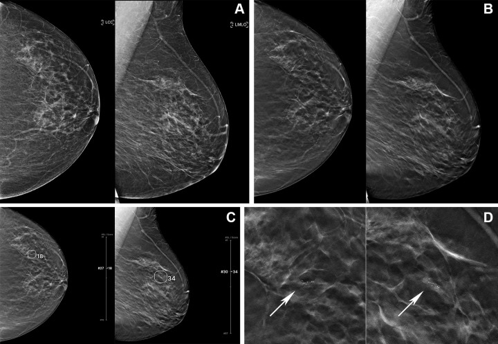 Digital mammography (DM) and digital breast tomosynthesis (DBT) images in a 61-year-old woman. (A) Left craniocaudal (LCC) and left mediolateral oblique (LMLO) views at DM and (B) LCC and LMLO views at DBT. In the reader study, six of 15 radiologists interpreted this case as negative for cancer. (C) The artificial intelligence (AI) algorithm for DBT images outlined the lesion with abnormality scores, which represent the likelihood of the presence of breast cancer, of 18 and 34, and five of the six readers changed their decision when aided by AI. (D) Zoomed-in LCC and LMLO DBT images show grouped fine and linear microcalcifications (arrows) in the left upper outer quadrant, which was histopathologically proven to be ductal carcinoma in situ.