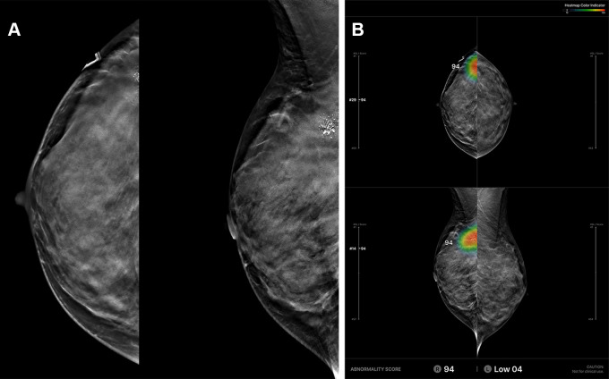 Example of a case with an abnormality analyzed by the artificial intelligence (AI)–based diagnostic support software. (A) Based on analysis of the algorithm for an input digital breast tomosynthesis (DBT) examination, (B) the resulting diagnostic support software (Lunit INSIGHT DBT) provides heatmap marks (or contour lines) and abnormality scores on suspicious lesions on three-dimensional sections with the Slice Navigation Bar and on synthetic two-dimensional mammography images at corresponding areas in the picture archiving and communication system. Additional dedicated viewer formats (In-App Viewer, Movie) could support the AI system.